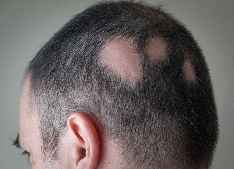 Preescolar infierno ficción Qué es la Alopecia Areata? Pérdida de Pelo | Almirall